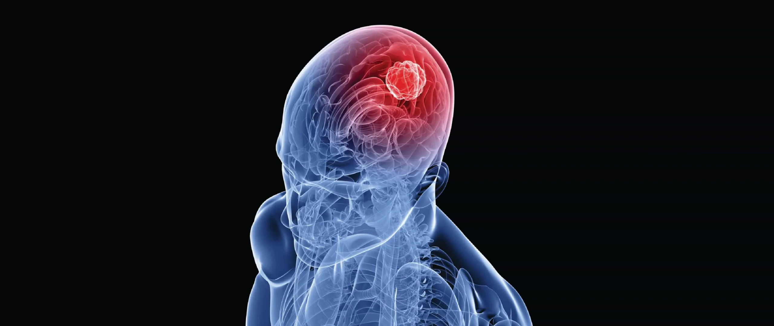 Leading the Fight Against Brain Tumors