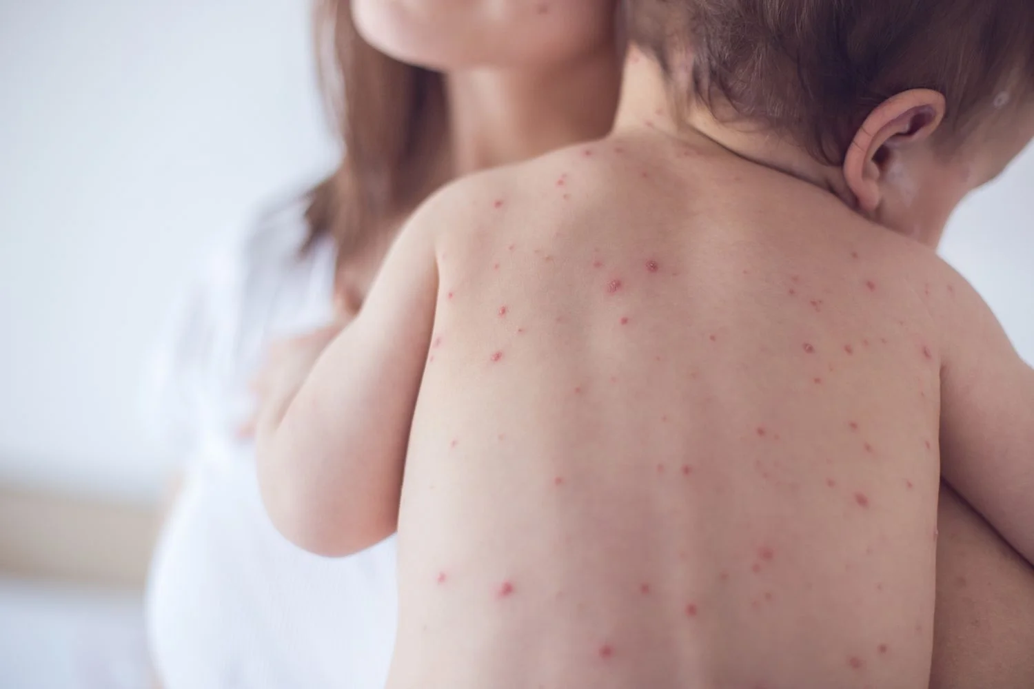 Measles Cases Among Children in West Midlands