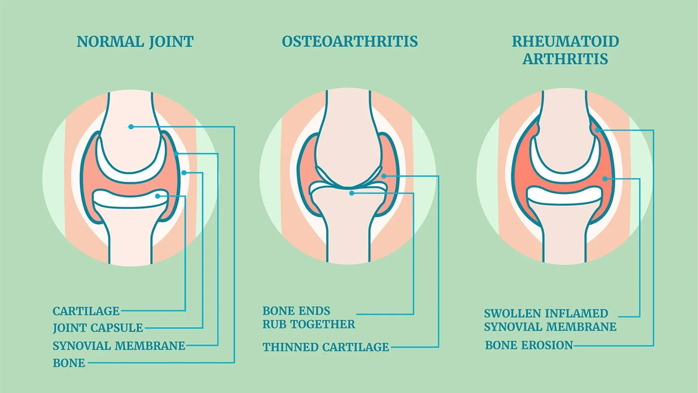 Rheumatoid Arthritis Treatment